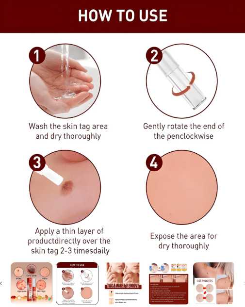 Professional Skin Tag & Mole Removal Device – Flawless Skin At Home - Housenvi